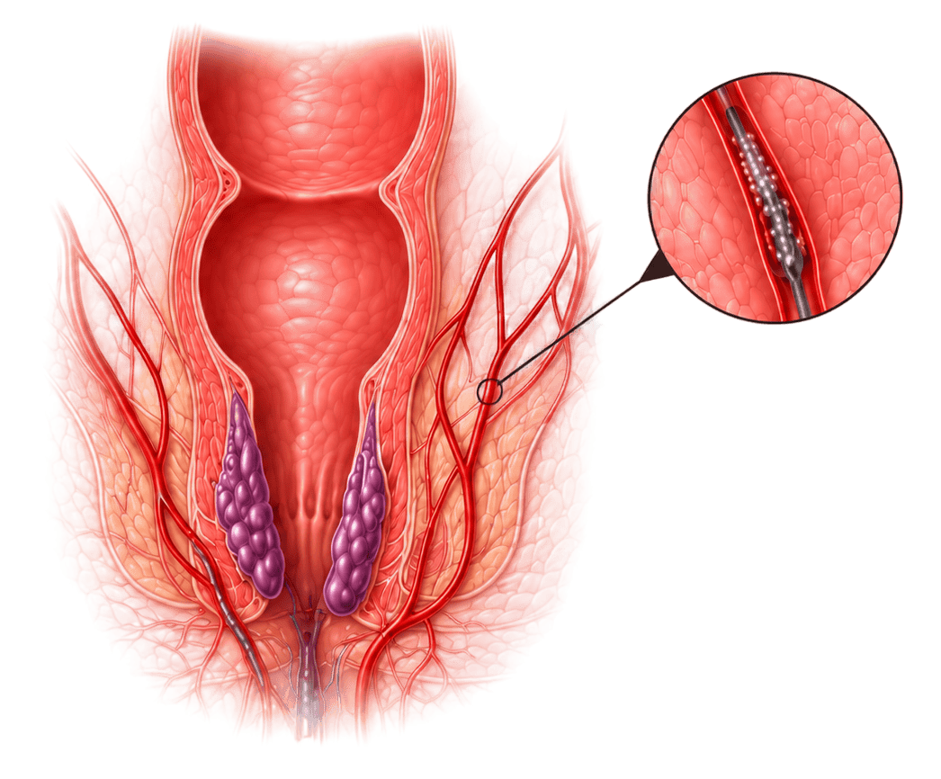 Hemorrhoidal Artery Embolization